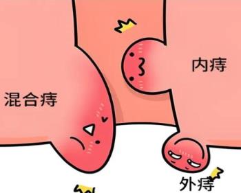 医用痔疮凝胶定制厂家